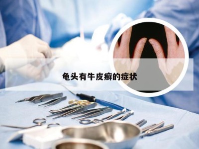 龟头有牛皮癣的症状