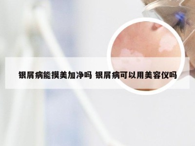 银屑病能摸美加净吗 银屑病可以用美容仪吗