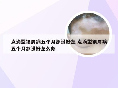 点滴型银屑病五个月都没好怎 点滴型银屑病五个月都没好怎么办