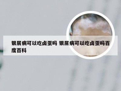 银屑病可以吃卤蛋吗 银屑病可以吃卤蛋吗百度百科