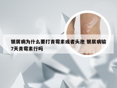 银屑病为什么要打青霉素或者头孢 银屑病输7天青霉素行吗