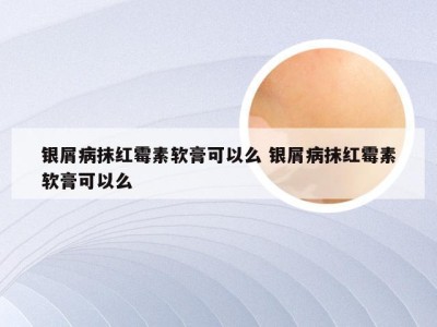 银屑病抹红霉素软膏可以么 银屑病抹红霉素软膏可以么