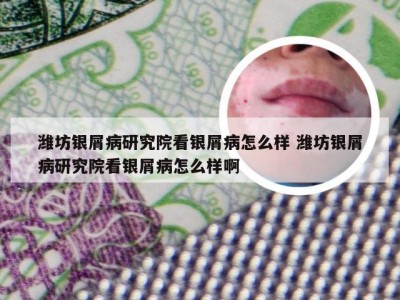 潍坊银屑病研究院看银屑病怎么样 潍坊银屑病研究院看银屑病怎么样啊