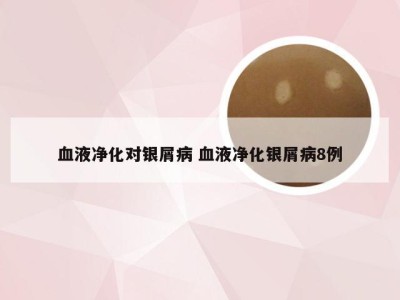 血液净化对银屑病 血液净化银屑病8例