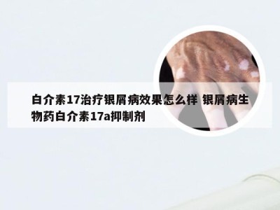 白介素17治疗银屑病效果怎么样 银屑病生物药白介素17a抑制剂