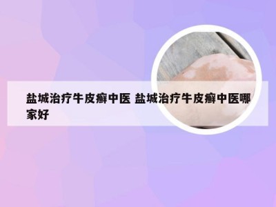 盐城治疗牛皮癣中医 盐城治疗牛皮癣中医哪家好