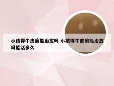 小孩得牛皮癣能治愈吗 小孩得牛皮癣能治愈吗能活多久