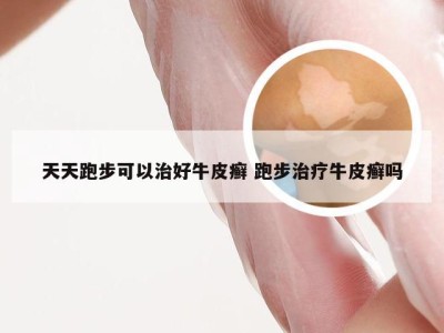 天天跑步可以治好牛皮癣 跑步治疗牛皮癣吗