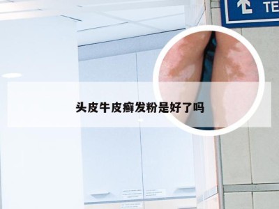 头皮牛皮癣发粉是好了吗