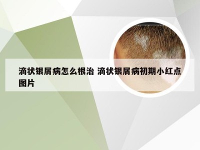 滴状银屑病怎么根治 滴状银屑病初期小红点图片