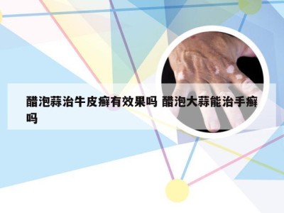 醋泡蒜治牛皮癣有效果吗 醋泡大蒜能治手癣吗