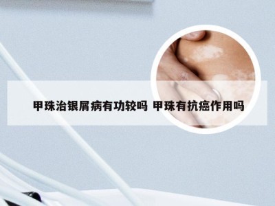 甲珠治银屑病有功较吗 甲珠有抗癌作用吗