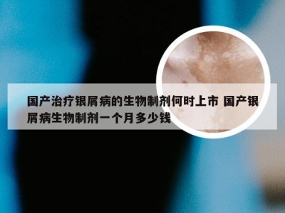 国产治疗银屑病的生物制剂何时上市 国产银屑病生物制剂一个月多少钱