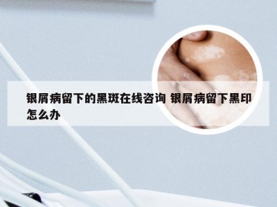 银屑病留下的黑斑在线咨询 银屑病留下黑印怎么办