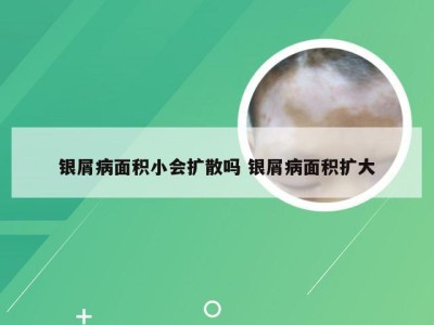 银屑病面积小会扩散吗 银屑病面积扩大