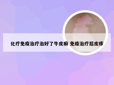 化疗免疫治疗治好了牛皮癣 免疫治疗后皮疹