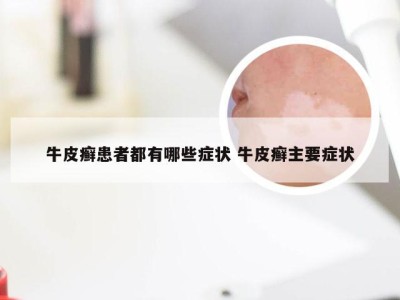牛皮癣患者都有哪些症状 牛皮癣主要症状