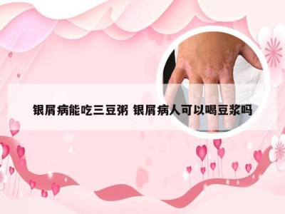 银屑病能吃三豆粥 银屑病人可以喝豆浆吗