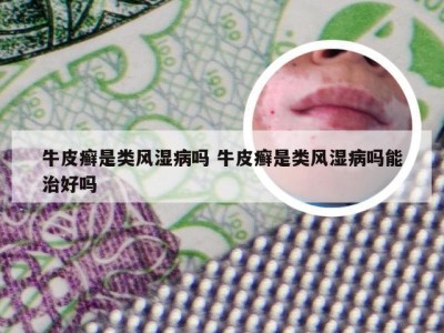 牛皮癣是类风湿病吗 牛皮癣是类风湿病吗能治好吗