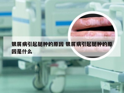 银屑病引起腿肿的原因 银屑病引起腿肿的原因是什么