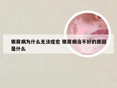 银屑病为什么无法痊愈 银屑病治不好的原因是什么