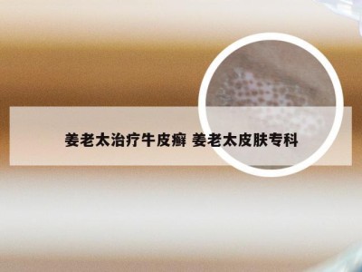 姜老太治疗牛皮癣 姜老太皮肤专科