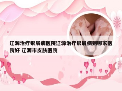 辽源治疗银屑病医院辽源治疗银屑病到哪家医院好 辽源市皮肤医院