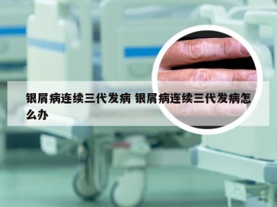 银屑病连续三代发病 银屑病连续三代发病怎么办
