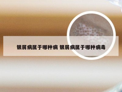 银屑病属于哪种病 银屑病属于哪种病毒