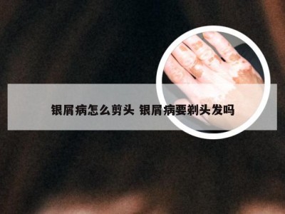 银屑病怎么剪头 银屑病要剃头发吗