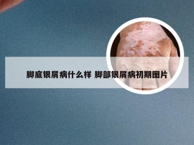 脚底银屑病什么样 脚部银屑病初期图片