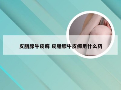 皮脂腺牛皮癣 皮脂腺牛皮癣用什么药