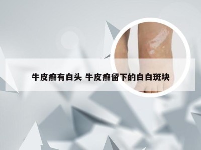牛皮癣有白头 牛皮癣留下的白白斑块