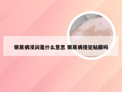 银屑病浸润是什么意思 银屑病侵犯粘膜吗