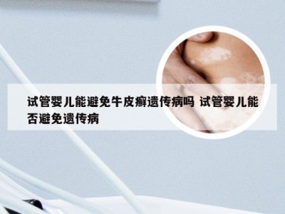 试管婴儿能避免牛皮癣遗传病吗 试管婴儿能否避免遗传病