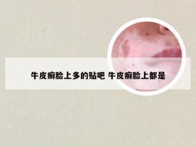 牛皮癣脸上多的贴吧 牛皮癣脸上都是