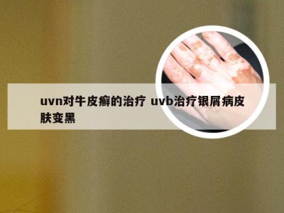 uvn对牛皮癣的治疗 uvb治疗银屑病皮肤变黑