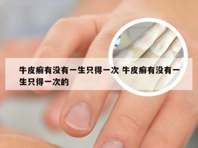 牛皮癣有没有一生只得一次 牛皮癣有没有一生只得一次的