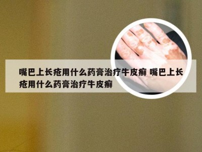 嘴巴上长疮用什么药膏治疗牛皮癣 嘴巴上长疮用什么药膏治疗牛皮癣