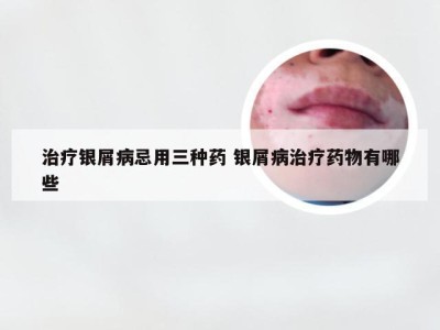治疗银屑病忌用三种药 银屑病治疗药物有哪些