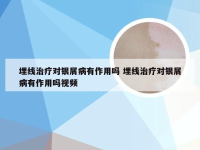 埋线治疗对银屑病有作用吗 埋线治疗对银屑病有作用吗视频