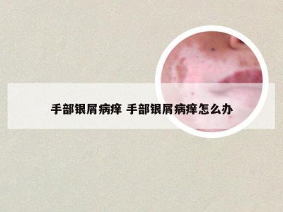 手部银屑病痒 手部银屑病痒怎么办