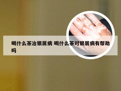 喝什么茶冶银屑病 喝什么茶对银屑病有帮助吗