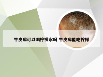 牛皮癣可以喝柠檬水吗 牛皮癣能吃柠檬