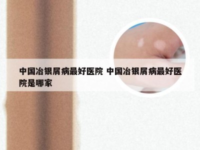 中国冶银屑病最好医院 中国冶银屑病最好医院是哪家