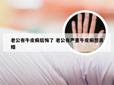 老公有牛皮癣后悔了 老公有严重牛皮癣想离婚