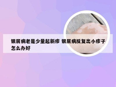 银屑病老是少量起新疹 银屑病反复出小疹子怎么办好