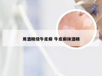 用酒精烧牛皮癣 牛皮癣抹酒精