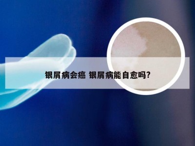 银屑病会癌 银屑病能自愈吗?