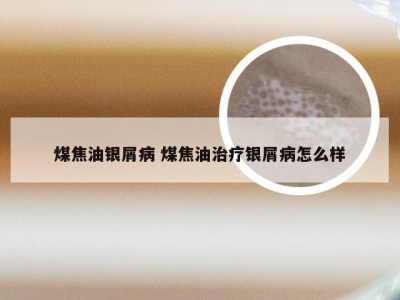 煤焦油银屑病 煤焦油治疗银屑病怎么样